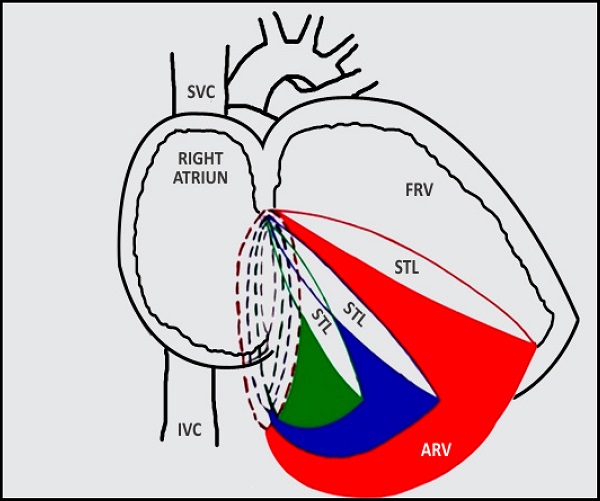 Schematic representation of severity of Ebstein's anomaly. As the
							displacement of septal tricuspid leaflet increases, there is a
							corresponding increase in true tricuspid annulus dilatation and a
							decrease in the amount of functional right ventricle. Broken lines
							indicate true tricuspid annulus. Coloured region indicates the thinned
							out atrialized right ventricle. Black - normal; green - mild dilatation;
							blue - moderate dilatation; and red - severe dilatation.