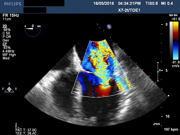 Transesophageal echocardiogram showing severe mitral
							regurgitation.