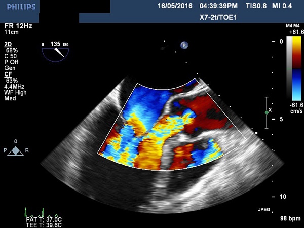 Transesophageal echocardiogram showing massive aortic
							regurgitation.