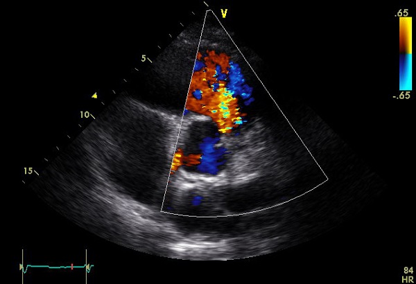 Transthoracic echocardiogram showing torrential pulmonary
							regurgitation.