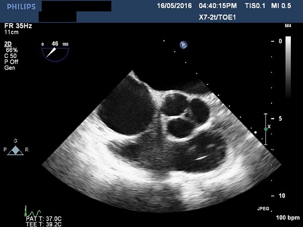 Transesophageal echocardiogram showing thickened aortic valve
							leaflets.