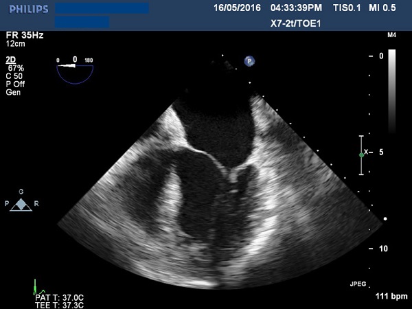 Transesophageal echocardiogram showing severely thickened mitral
							valve leaflets.