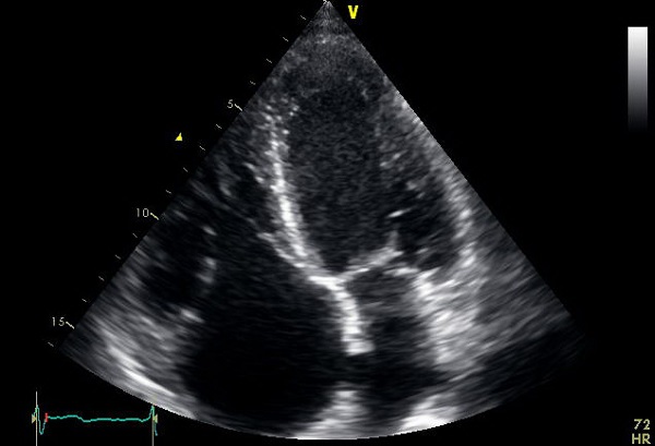 Transthoracic echocardiogram showing severely thickened tricuspid
							valve leaflets.