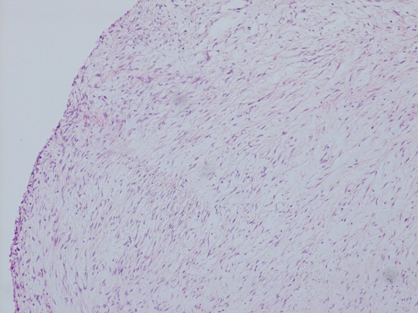 Histology slide of carcinoid aortic valve.