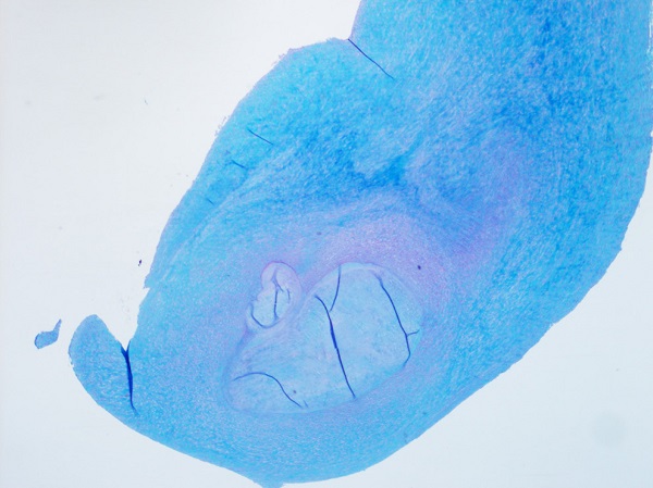 Histology slide of carcinoid mitral valve.