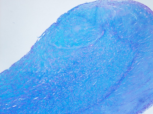 Histology slide of carcinoid pulmonary valve.