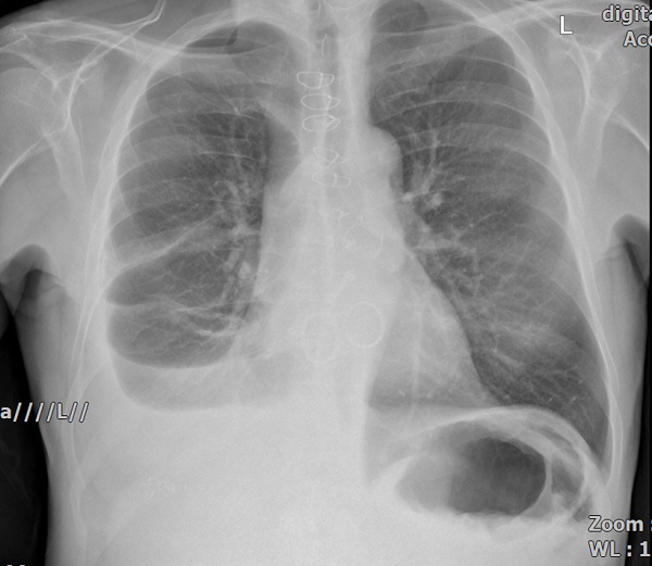 Chest X-ray showing all four replaced valves.