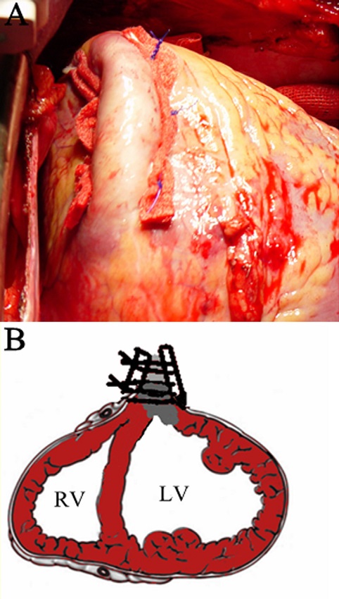 Off-pump plication repair technique of left ventricular aneurysm.
								(A) Linear plication was performed with Teflon felt successively in
								a horizontal mattress fashion. (B) Schematic diagram showed the
								linear plication.