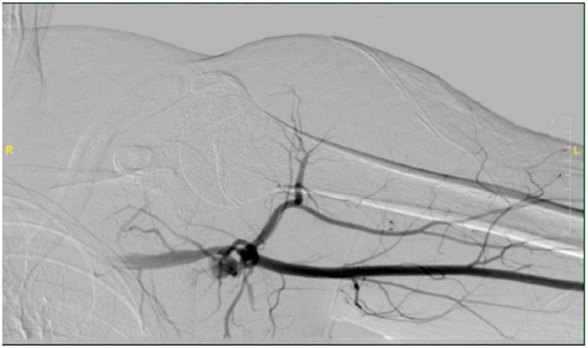 Angiogram showing contrast extravasations from the left axillary
							artery.