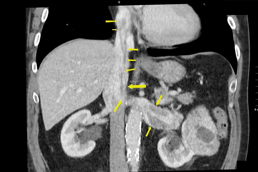 CT scan of male patient with left kidney tumor and thrombus
							propagation up to the right atrium.