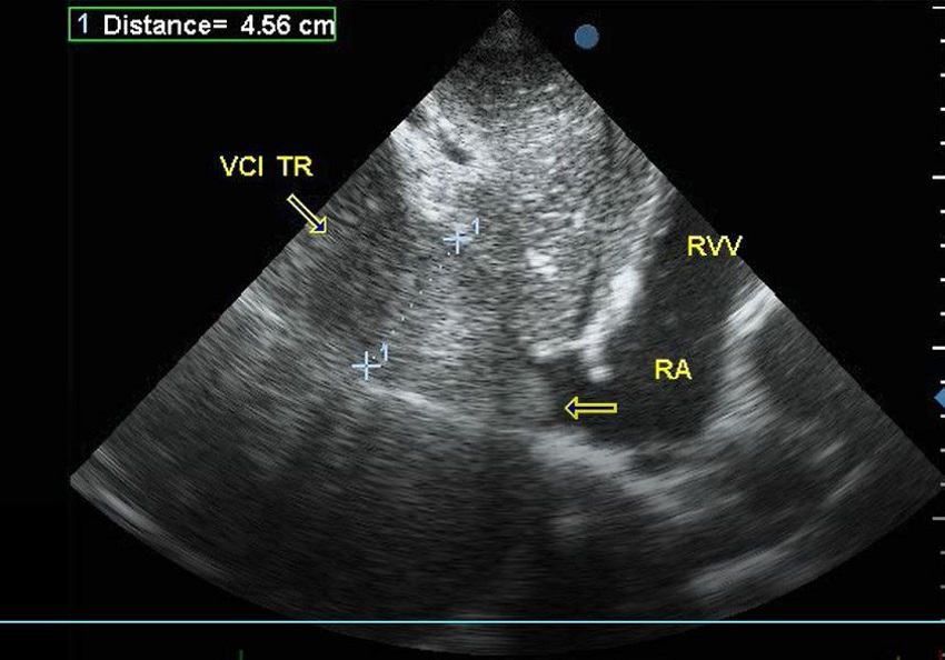 Echocardiogram in female patient with IVC tumor and
							supradiaphragmatic propagation.