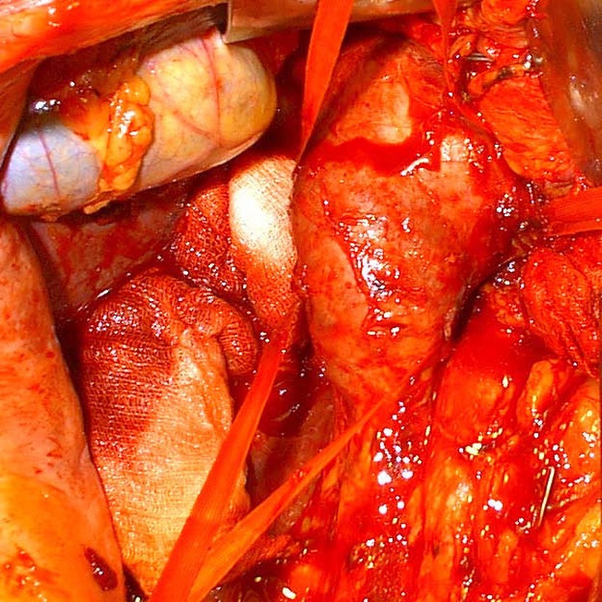 Presentation of inferior vena cava in male patient with left kidney
							tumor and thrombus propagation up to the right atrium.