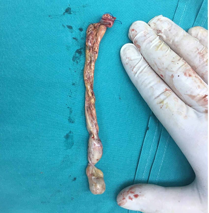 Tumor thrombus from female patient extending to the
							supradiaphragmatic portion of IVC.