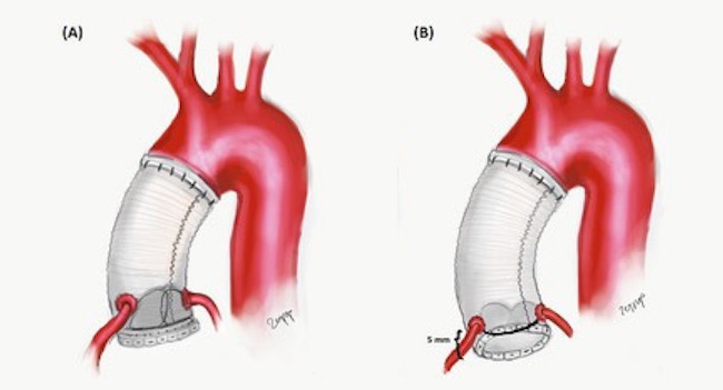 Depiction of button Bentall (A) and flanged Bentall (B) procedures.
