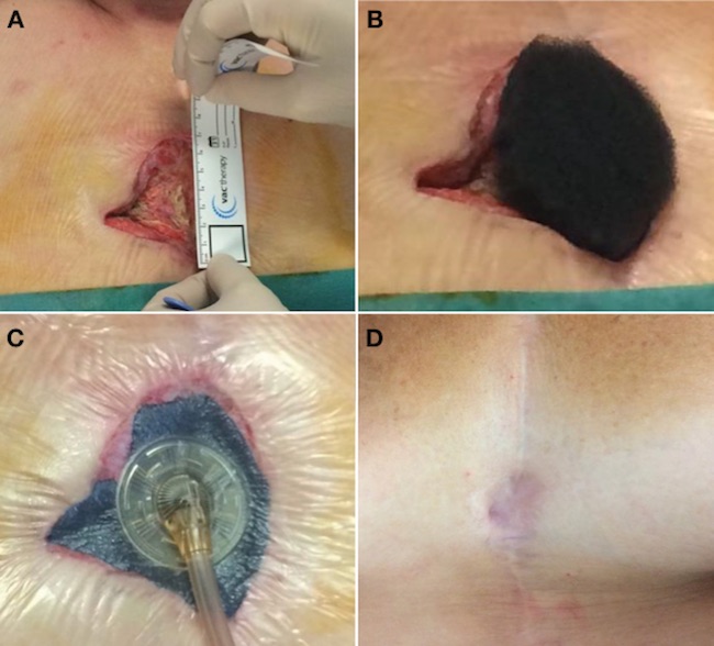 A) Measurement of the wound size; B) Tailoring of the foam; C) Vacuum therapy device in place; D) Final results two years after 19 days of vacuum therapy and direct surgical closure with acceptable cosmetic results.