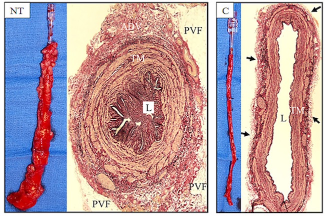 Examples of no-touch (NT) and conventional (C) saphenous vein (SV) grafts. The left panels show representative SV explants using both harvesting techniques. NT SV has its surrounding cushion of fat intact and has not been distended. C SV has the fat removed and has been distended to overcome spasm. The transverse section of NT SV shows an intact surrounding cushion of perivascular fat (PVF), an undamaged adventitia (ADV) and thick media (TM). As this vessel has not been distended, the lumen (L) is thrown into folds. The section of C SV exhibits various forms of damage. Much of the ADV has been stripped off, almost to the level of the external elastic lamina (small arrows). The media is thinner than that of the NT SV and L is grossly dilated, both due to high pressure intraluminal distension (Kopjar et al., 2016)[22].