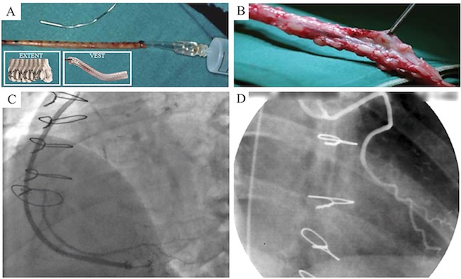 Unsupported and supported saphenous vein (SV) grafts for coronary artery bypass grafting. A) An example of a conventionally harvested SV with outermost tissue removed (Rueda et al.[36], 2008). Insert, examples of DacronTM &lsquo;EXTENT&rsquo; and &lsquo;VEST&rsquo; external supports (Mawhinney et al.[58], 2017). B) An example of a no-touch (NT) harvested SV with external tissue intact (Rueda et al.[36], 2008). C) Angiogram of an SV with VEST at 12-month follow-up (Mawhinney et al.[58], 2017). D) NT SV harvesting prevents kinking of excessively long graft (Rueda et al.[36], 2008).