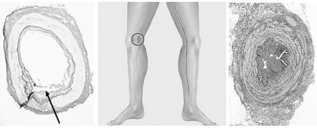 Saphenous vein (SV) histology of endoscopic vein harvesting (EVH) vs. no-touch (NT) techniques. Left panel is a transverse section of an SV prepared with EVH. The perivascular layers and endothelium are damaged. The arrow shows intimal tearing (Kiani et al.[69], 2011). Middle panel to the left shows a diagram with a small incision above the knee used for insertion of EVH instruments. To the right, it shows a long incision in thigh and calf used for both open vein harvesting and NT harvesting. Right panel is a transverse section of a NT harvested SV with perivascular fat and adventitia intact and endothelium undamaged (Kopjar et al.[22], 2016).