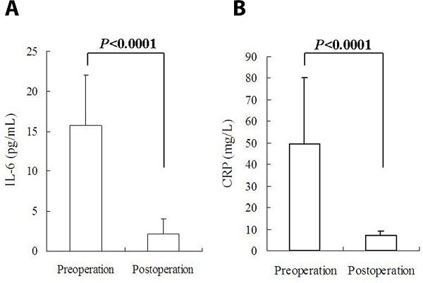 Circulating inflammatory biomarkers were significantly lower
								after cardiac myxoma resection than preoperative baseline: (A)
								interleukin-6 (IL-6); and (B) C-reactive protein (CRP).
