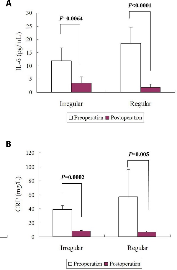 Comparisons of circulating biomarkers between patients with
								cardiac myxoma of an irregular gross appearance and those with
								cardiac myxoma of a regular gross appearance: (A) no differences
								were found in pre- or postoperative interleukin-6 (IL-6) levels
								between these patients; and (B) no differences were found in pre- or
								postoperative C-reactive protein (CRP) levels between these
								patients.