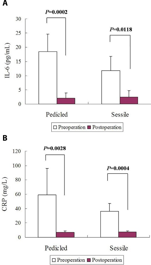 Comparisons of circulating biomarkers between patients with a
								pedicled or sessile cardiac myxoma: (A) no differences were found in
								pre- or postoperative interleukin-6 (IL-6) levels between these
								patients; and (B) no differences were found in pre- or postoperative
								C-reactive protein (CRP) levels between these patients.