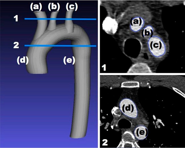 Substructures of the heart model in this study shown in relation to
							two slices out of the 400 slices of computed tomography scans. The
							structures are the ascending aorta (d), descending aorta (e), subclavian
							artery (a), left common carotid artery (b), and brachiocephalic artery
							(c). The two slices were captured on a two-dimensional plane marked with
							horizontal lines (1&2).