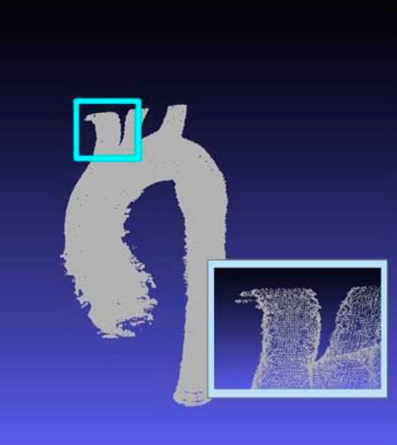 The multiple dots that make up the dataset. The brachiocephalic
							artery and portions of the left common carotid artery are magnified in
							the inset.