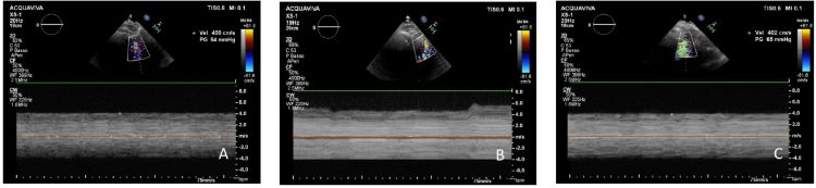 Transthoracic echocardiographic recordings of continuous-wave
								Doppler flow velocity signals in the same patient. Normal control
								(A), during left ventricular assist device thrombosis (B), and after
								thrombolysis (C). Note the intermittent oscillation of flow signal
								in B due to thrombotic obstruction. No oscillations of the flow
								signal are present in A and C.