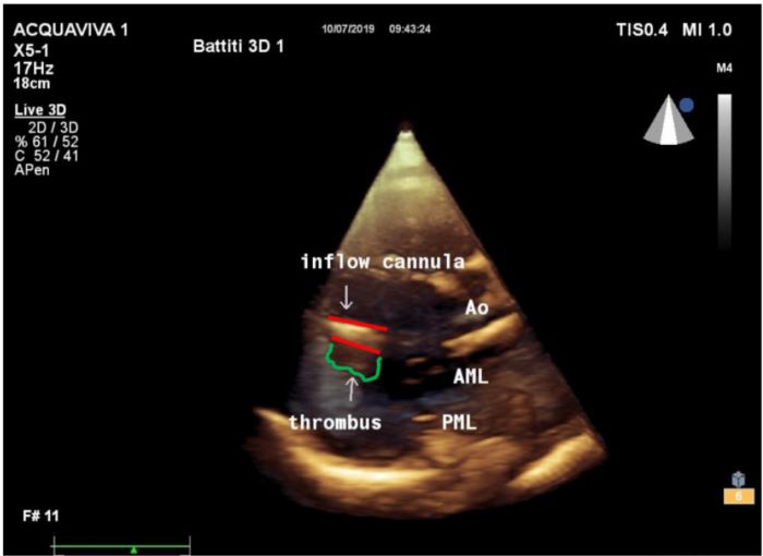 Three-dimensional transthoracic echocardiography. Apical view of
								the left ventricle: red lines mark both sides of the inflow cannula.
								The thrombus attached at the bottom side of the cannula is marked in
								green: the thrombus is not wedging into the cannula, excluding a
								pre-pump thrombosis. AML=anterior mitral leaflet; Ao=aortic valve;
								PML=posterior mitral leaflet