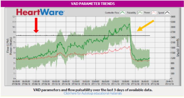 Logfile recording of a thrombotic event in a HVAD. Power
								consumption (red line) and blood flow (green line) surge abruptly
								well above normal range (red arrow). These logfiles features are
								typical of an intra-pump thrombosis. From the beginning of
								thrombolysis, a decrease of these parameters back down to normal
								values takes place (yellow arrow). LPM=liter per minute;
								VAD=ventricular assist device