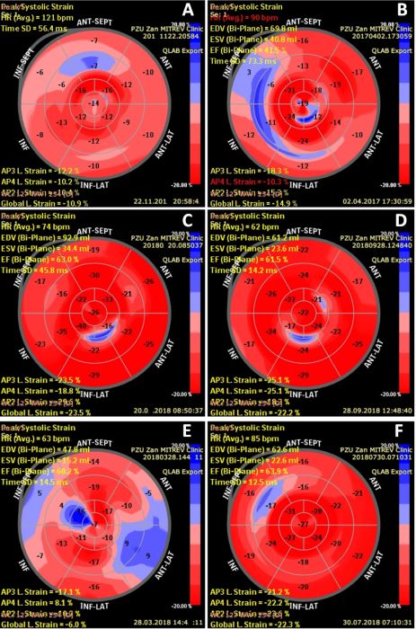 Representative bull’s-eye images of patients presenting
with normal versus abnormal preoperative GLS. Panels A and B show
preoperative and postoperative bull’s-eye images of a patient
with preoperative abnormal GLS who experienced minor, but clinically
insufficient, improvement in LV systolic function and myocardial
contractility. Panels C and D show perioperative bull’s-eye
images of a patient with normal GLS. Panels E and F display images
of a patient with impaired subclinical LV systolic function at
baseline which improved during the postoperative course.