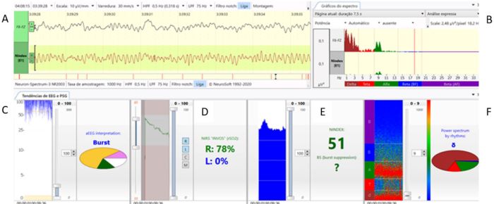 Parameters exhibited vertically in a 10-minute trend window: A)
                            continuous electroencephalogram; B) spectral graphic (spectrum); C)
                            amplitude-integrated electroencephalogram (aEEG); D) rScO2; E) NINDEX
                            and F)-spectrogram, recorded at Fz-F8 channel from a two-years old
                            patient undergoing ventricular septal defect repair.
