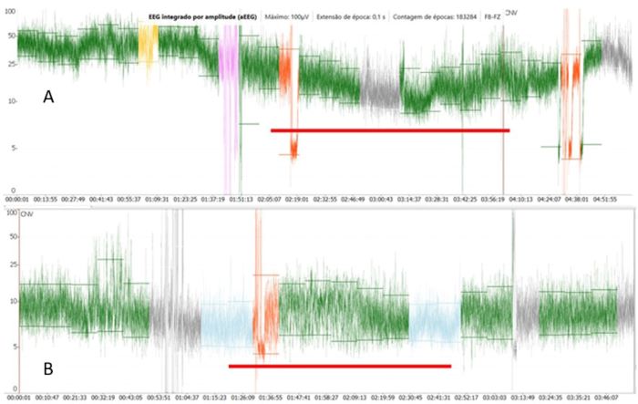 Two frontal channels aEEG complete recordings from two patients
                                with general anesthesia maintained with sevoflurane, remifentanil,
                                and dexmedetomidine: A) Five-months and 20-days of age patient
                                undergoing atrioventricular canal defect repair; B) one-month and
                                25-days of age patient undergoing Tetralogy of Fallot repair. The
                                amplitudes (maximum, minimum, and average) and the background
                                patterns trends are appropriate for their ages. However, the upper
                                trace have higher amplitudes and less variations that may reflect
                                the cerebral maturation during the first year of life.