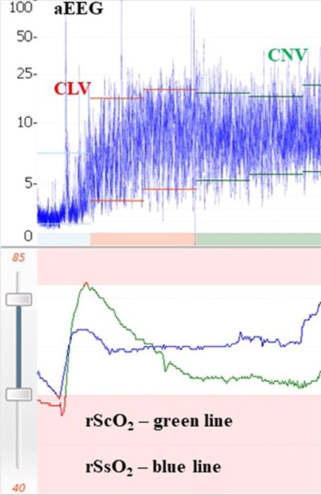 Recovery of cerebral (rScO2) and somatic (rSsO2) regional
                                oximetry in a neonate after cardiovascular arrest during
                                Transposition of Great Arteries repair with simultaneous
                                electrophysiologic recovery accessed by amplitude-integrated
                                electroencephalogram (aEEG). CLV=continuous low voltage;
                                CNV=continuous normal voltage.