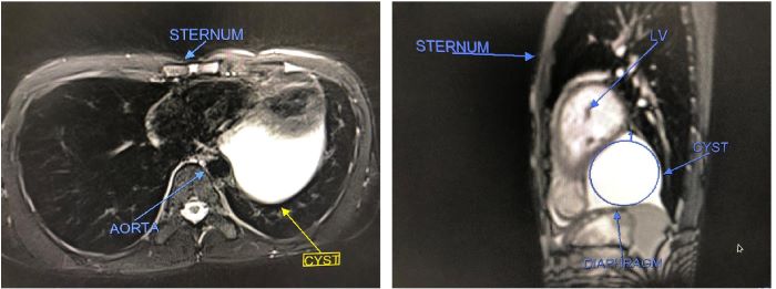 MRI in transverse section and sagittal view showing a
								well-defined cystic mass in the posterior and lateral portion
								abutting the left cardiac border.
