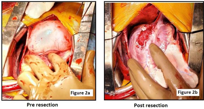 (A)Intraoperative image depicting large size of cyst and feeder
								vessels over the surface.(B)Postoperative image showing cyst floor
								with erosion of myocardial tissue and plicated edges.