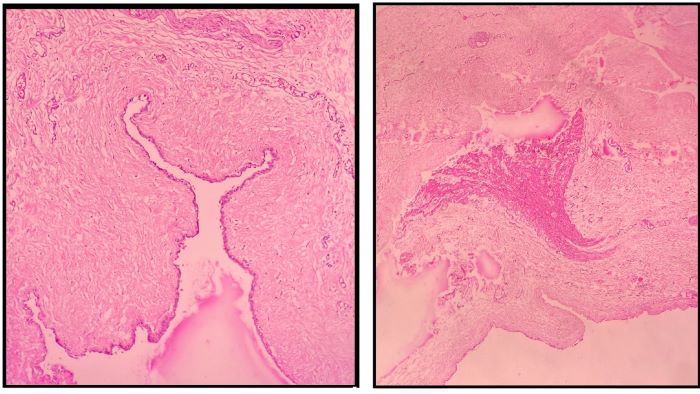 Histopathological images showing a single layer of mesothelial
								cells and blood and lymphatic vessels, smooth muscle cells,
								lymphocyte infiltration, and fibrosis.