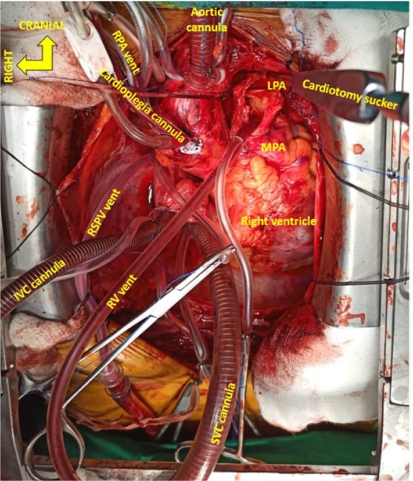 Cannulae and vent setup. Main pulmonary artery (MPA) arteriotomy extending to left pulmonary artery (LPA) with cardiotomy sucker in LPA shown. IVC=inferior vena cava; RPA=right pulmonary artery; RV=right ventricular; RSPV=right superior pulmonary vein; SVC=superior vena cava
