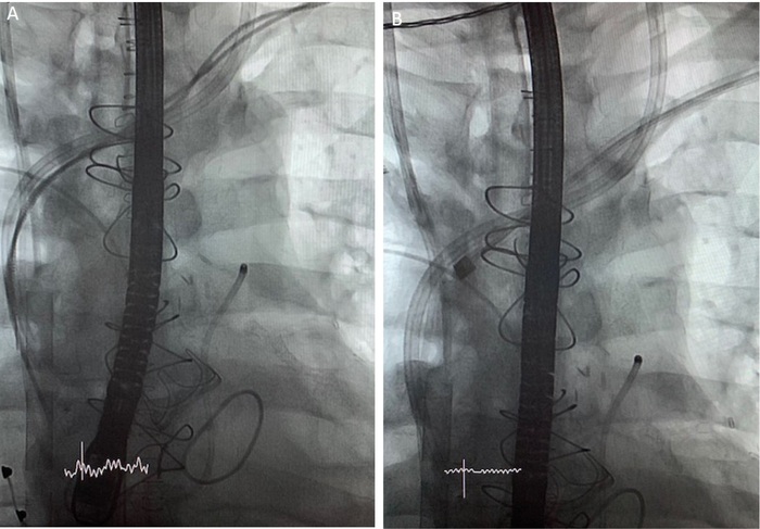 (A) Intraprocedural fluoroscopy showing 2 pacemaker leads that have been distally cut during an open surgical procedure and venous ECMO cannula ending in the right atrium. (B) Laser lead extraction procedure with RV lead in laser sheath.