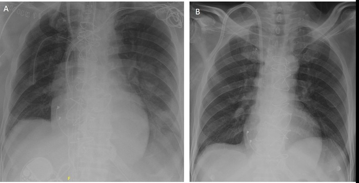 (A) Chest radiography after triple valve surgery, with remaining lead fragments and venous ECMO cannula in the right atrium. (B) Chest radiography after lead extraction and ECMO explantation.