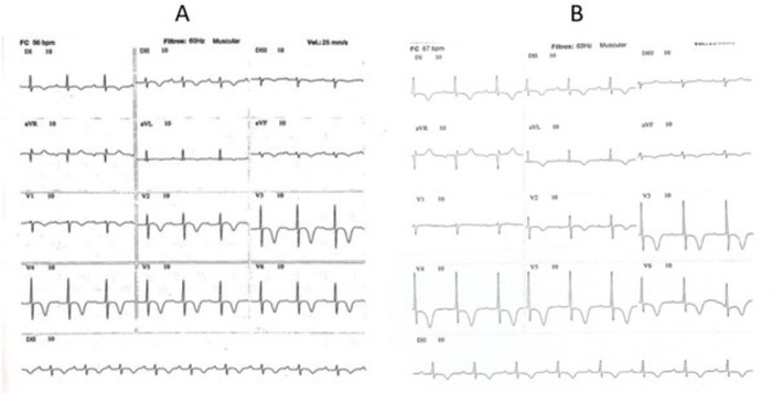 A) Electrocardiogram (ECG) from 2013. B) ECG from 2015. In A) and B) we can see peaked, inverted, and symmetrical T waves in V2, V3, V4, and V5.