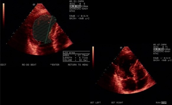 Echocardiogram (diastole and systole) from February 6, 2013 showing the typical Takotsubo left ventricular abnormality.