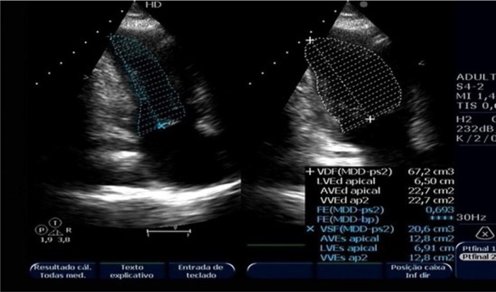 Echocardiogram (diastole and systole) from April 3, 2015 showing left ventricular abnormality, with the typical Takotsubo format.