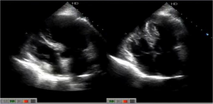 Echocardiogram (diastole and systole) from November 25, 2018 showing abnormality in the left ventricle, with the typical Takotsubo format.