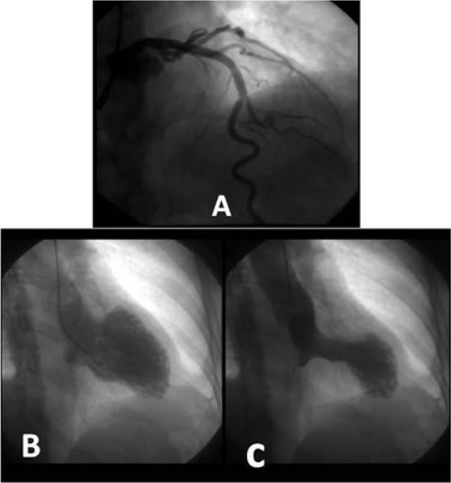 A) Cineangiocorography (CATH) from October 14, 2015 showing no signal of obstructive alterations. B and C) CATH (diastole and systole, respectively) from October 14, 2015 showing left ventricular abnormality, with the typical Takotsubo format.