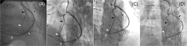 Patent no-touch saphenous vein (SV) Y-composite grafts based on
								the in situ left internal thoracic artery (ITA) at (A) early
								postoperative, (B) 1-year, (C) 5-year, and (D) 10-year angiographies
								in a 54-year-old male patient enrolled in the SAVE RITA trial. The
								in situ left ITA was anastomosed to the second diagonal (black
								arrowheads) and left anterior descending coronary arteries (white
								arrowheads), and the SV was anastomosed to the first diagonal (black
								arrows) and distal obtuse marginal (white arrows) and right
								posterolateral coronary arteries (white thin arrows) using a
								sequential anastomotic technique. SAVE RITA=SAphenous VEin versus
								Right Internal Thoracic Artery as a Y-Composite Graft