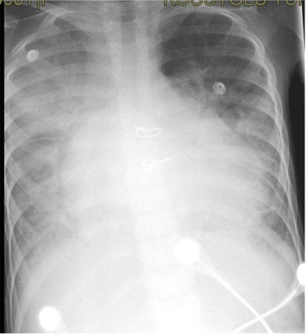 Tele-imaging of the case with dilated cardiomyopathy who
									is positive for coronavirus disease 2019.