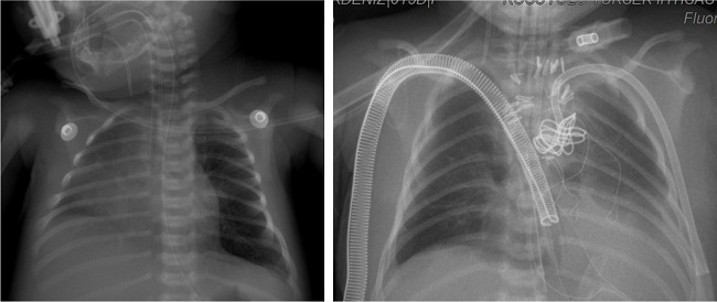 Preoperative and postoperative tele-imaging of the
									patient whose coronavirus disease 2019 real-time polymerase
									chain reaction (RT-PCR) test was negative but whose mother&rsquo;s
									RT-PCR was positive and who underwent Norwood stage 1
									operation.