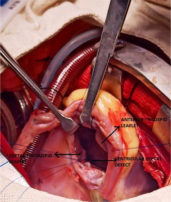 Intraoperative picture.