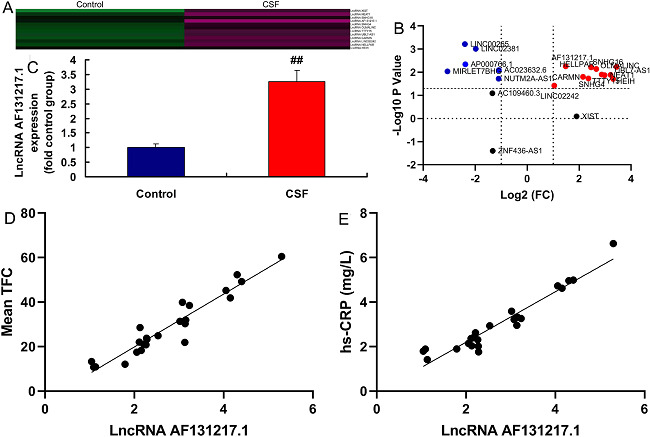 Long noncoding ribonucleic acid (lncRNA) AF131217.1 expression in
								the coronary slow flow (CSF) model. Heat map and volcano figure of
								gene chip (A and B), quantitative real-time polymerase chain
								reaction of lncRNA AF131217.1 expression (C) in the CSF model. The
								mean thrombolysis in myocardial infarction frame count (TFC) was
								positively correlated with lncRNA AF131217.1 levels (D) and
								high-sensitivity C-reactive protein (hsCRP) levels (E). Control,
								normal volunteer group; hsCRP, hsCRP patients group.
								##P<0.01 compared with normal volunteer group.